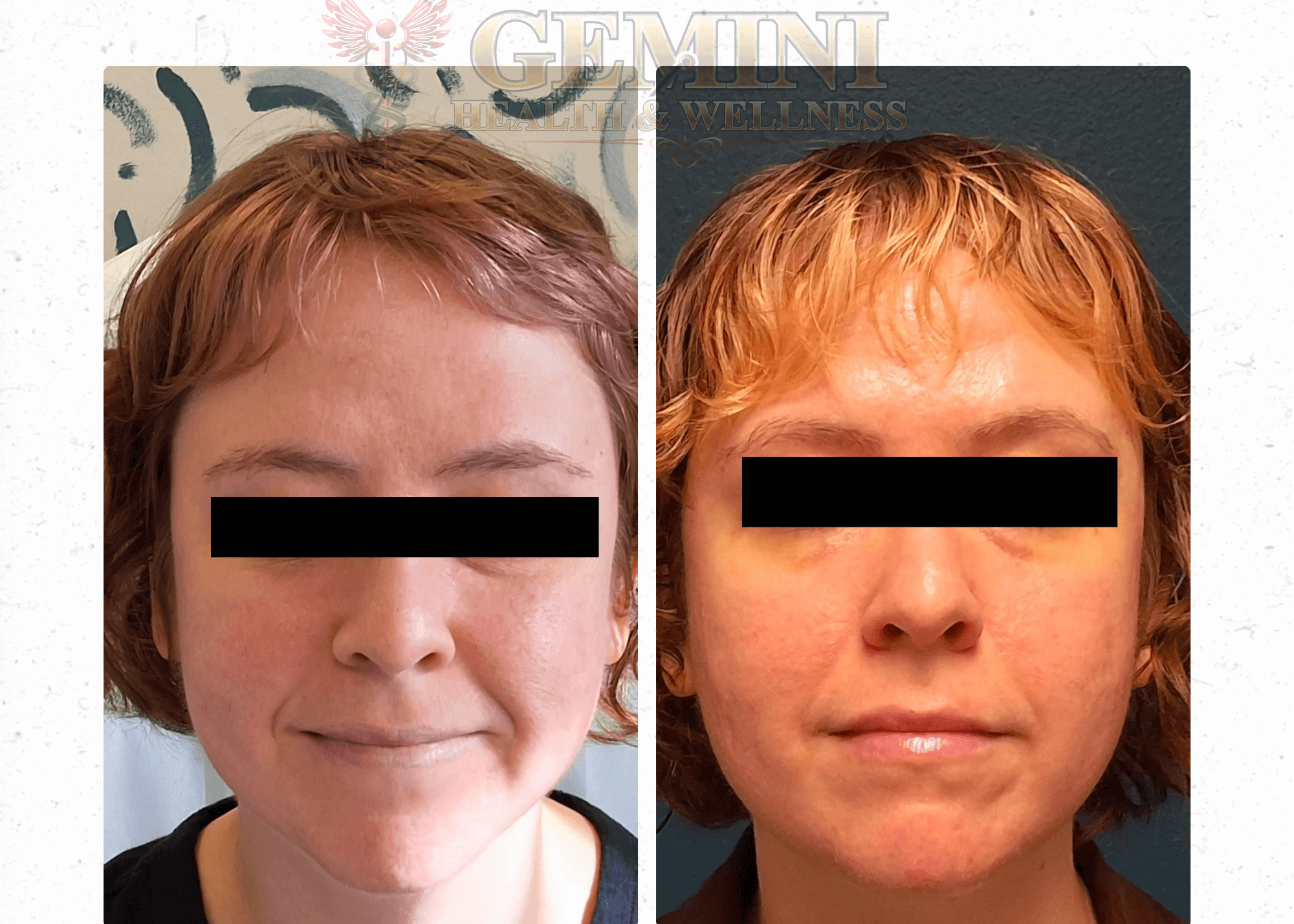 Transformative Benefits of RF
